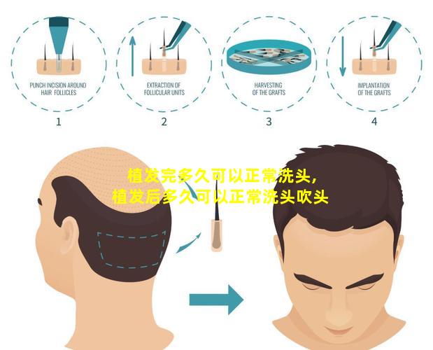 植发完多久可以正常洗头,植发后多久可以正常洗头吹头