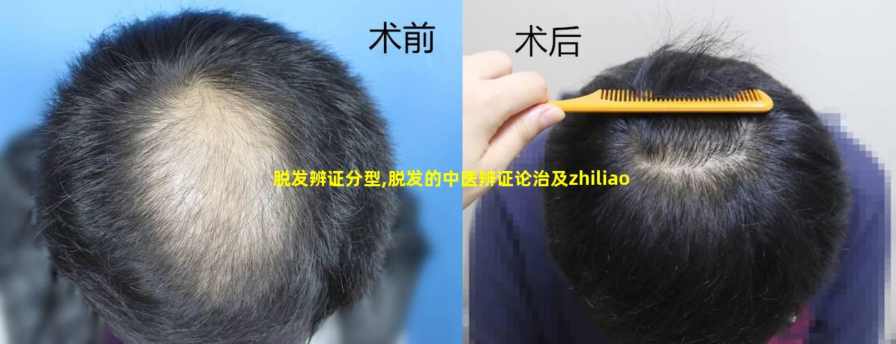 脱发辨证分型,脱发的中医辨证论治及zhiliao